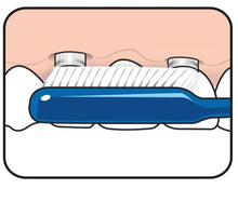 Load image into Gallery viewer, TePe Implant Orthodontic™