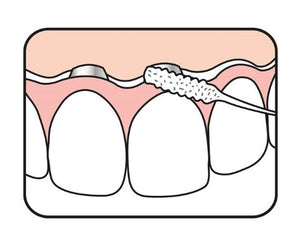 TePe Bridge and Implant Floss ™ 30's