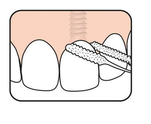 TePe Bridge and Implant Floss ™ 30's